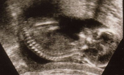 Fetus in womb