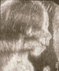 Ultrasound of baby's head