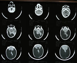 CT scan of brain