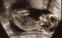 Fetal Ultrasound 2