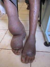 Elephantiasis