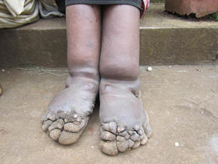 Elephantiasis1