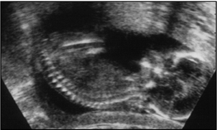 Ultrasound pregnancy